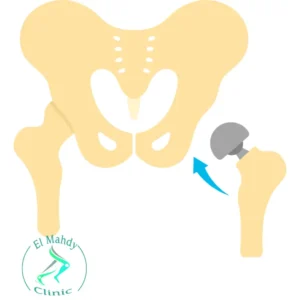 عملية تغيير مفصل الفخذ لكبار السن