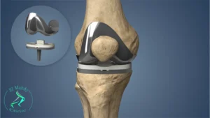 سبب تورم الرجل بعد عملية تغيير مفصل الركبة